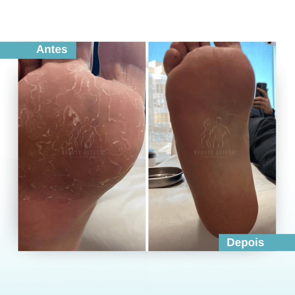 Fungos nos pés