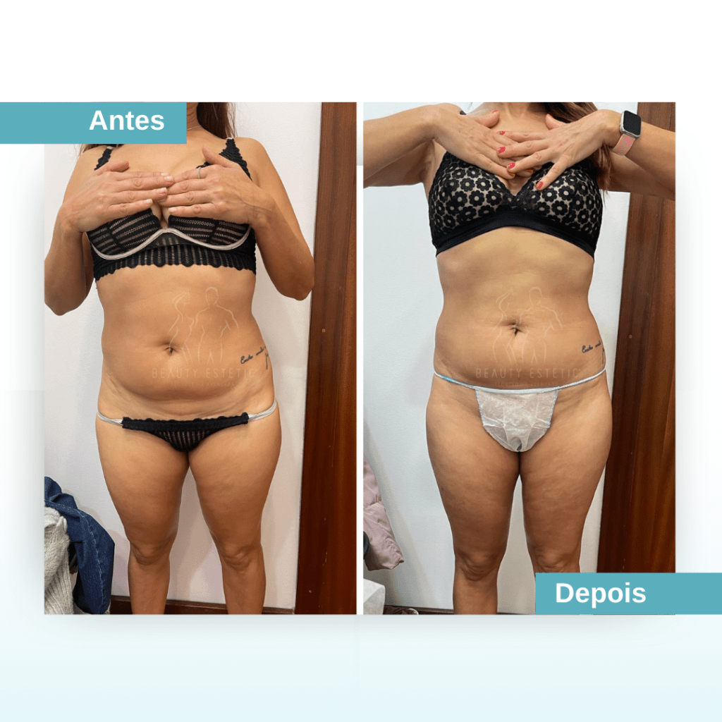 Antes e depois