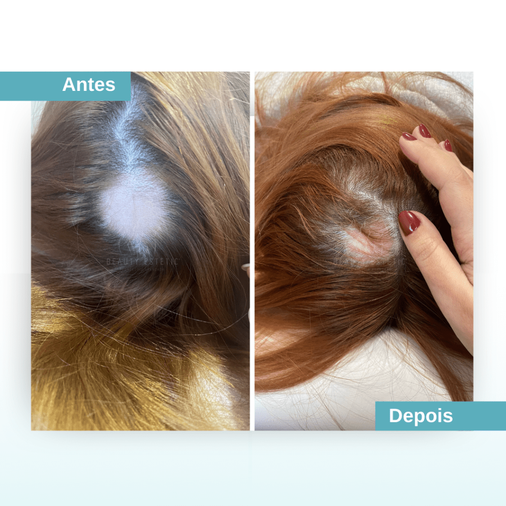 Tratar queda de cabelo