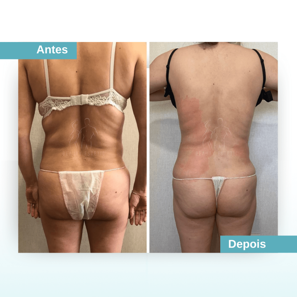 Antes e depois