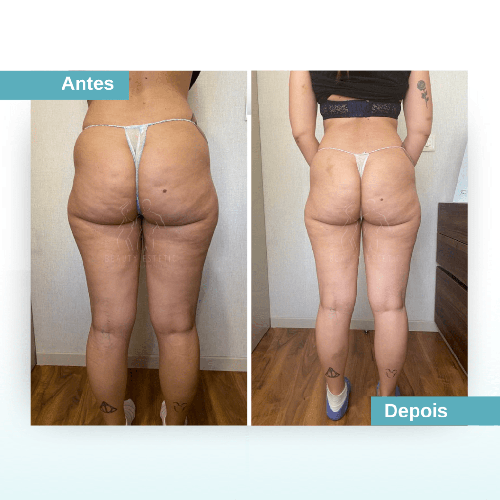 Antes e depois