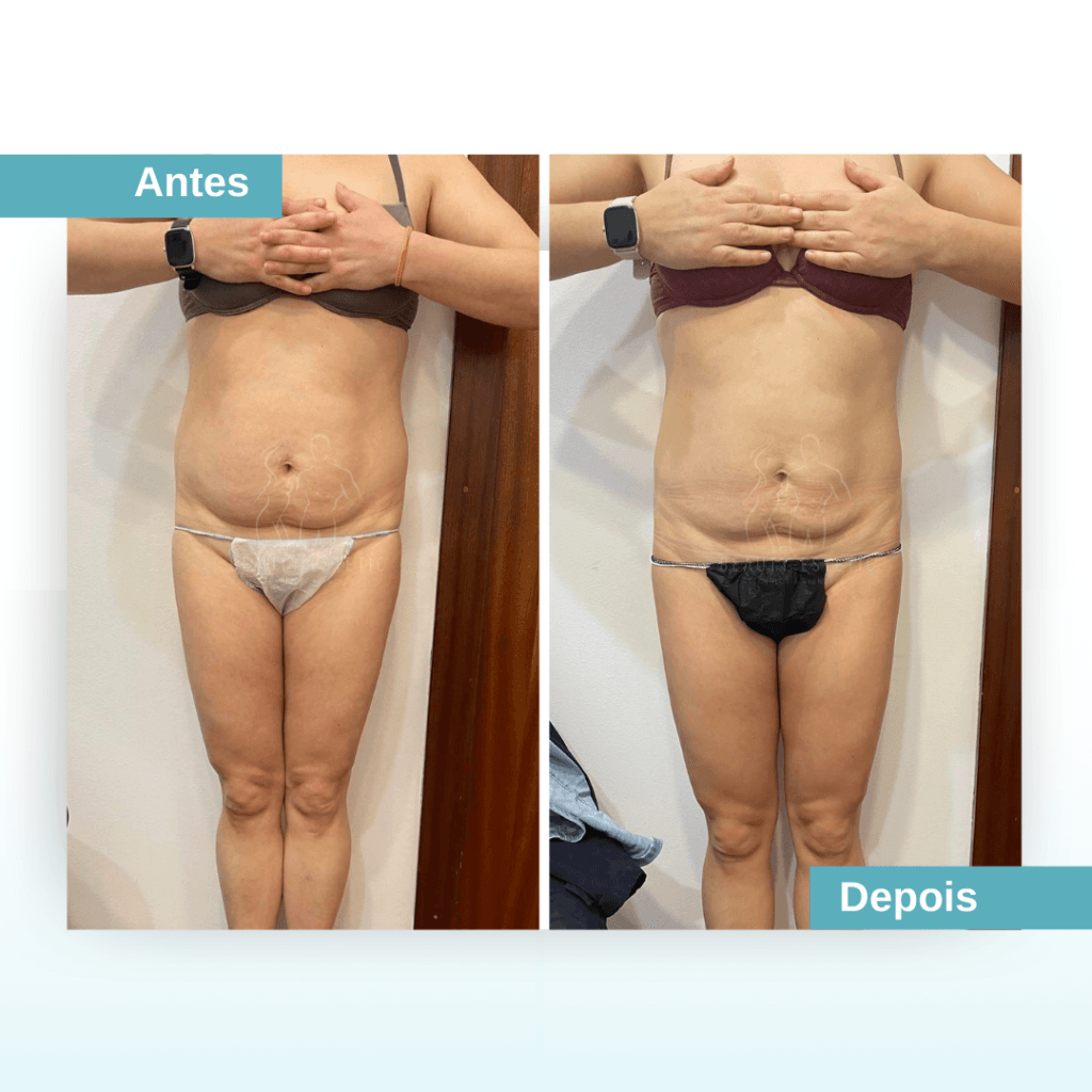 Diminuir barriga