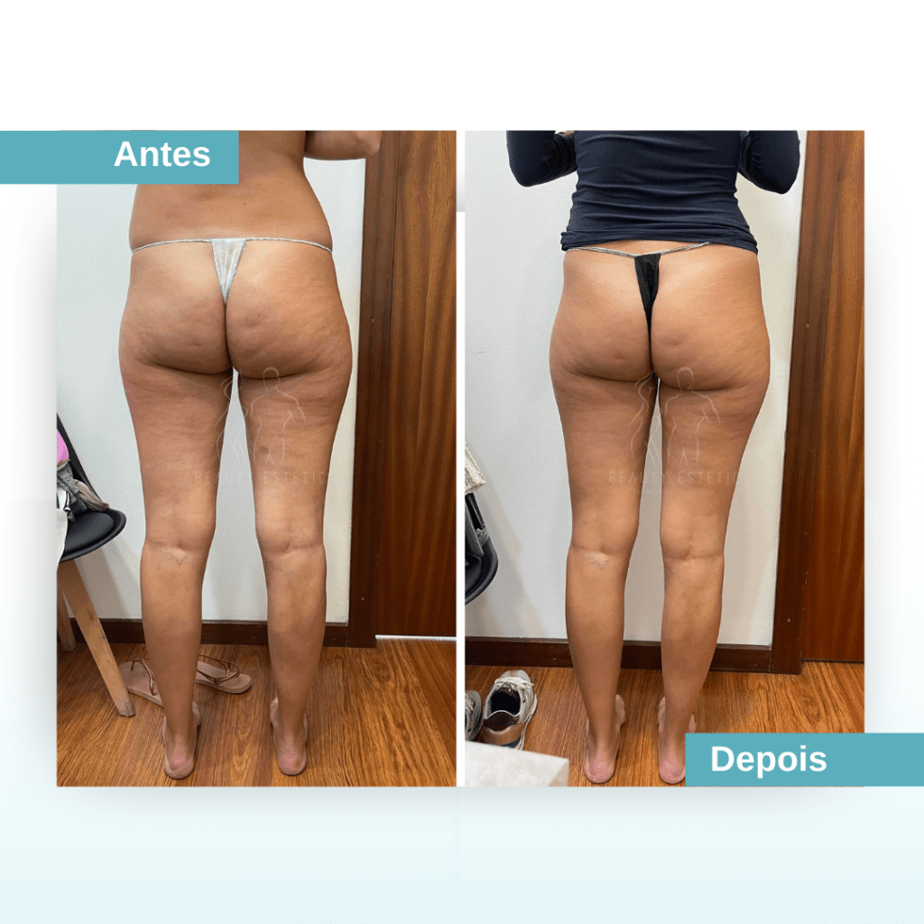 Tratamento para a Celulite