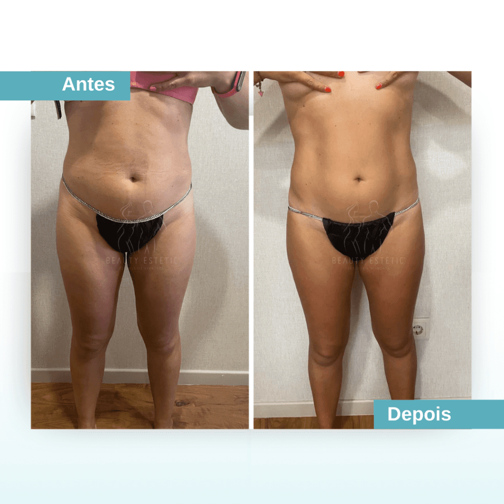 Tratamento barriga