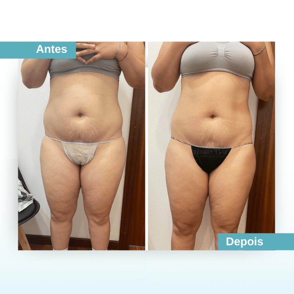 Gordura na barriga