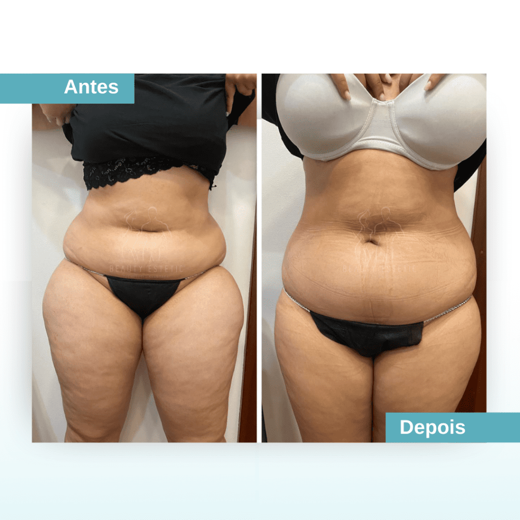 Tratamento gordura localizada na barriga