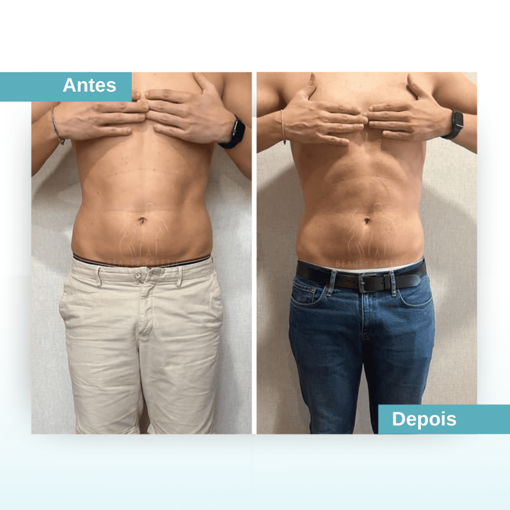 Tratamento gordura na barriga