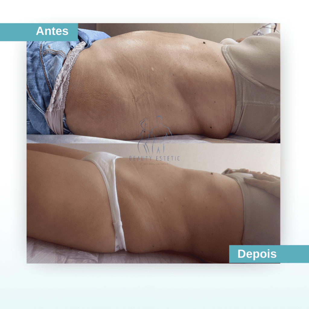 Reduzir gordura na barriga