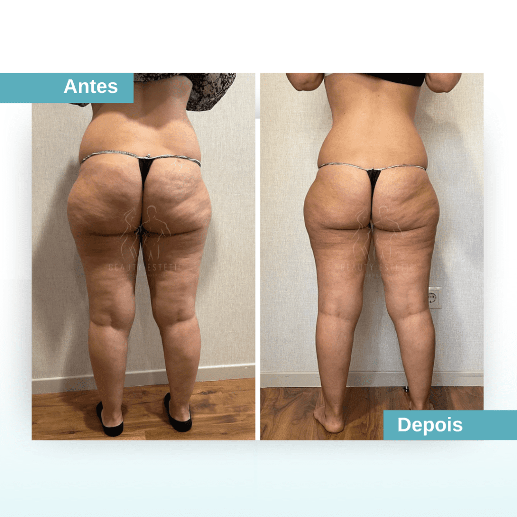 Tratamento celulite