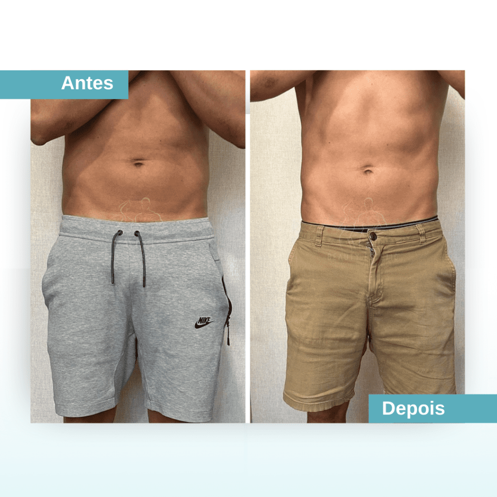 Resultado antes e depois abdominais