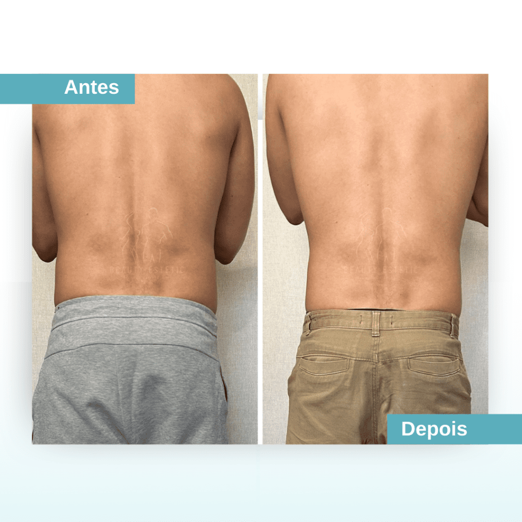 Resultado antes e depois costas
